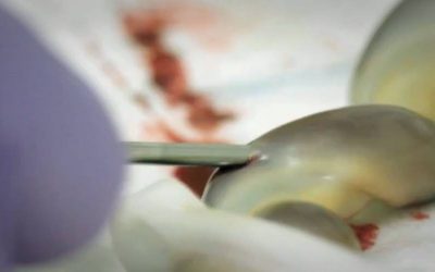 VIDEO: Pogledajte kako izgleda postupak prikupljanja matičnih ćelija iz pupčanika nakon porođaja
