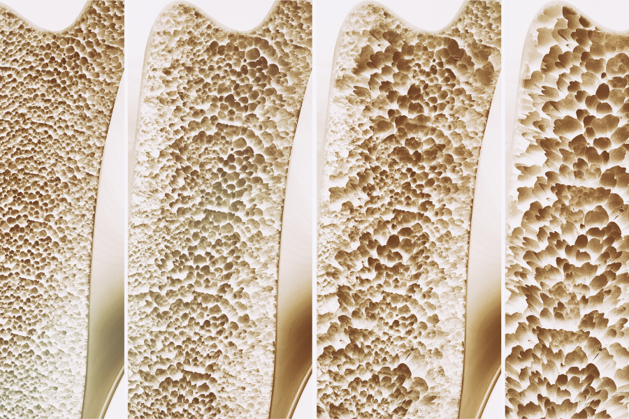 Graft Versus host Desease (GvHD)